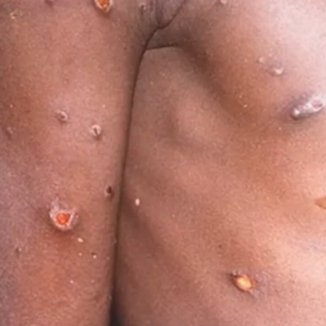 Roughly 20 Contacts of Monkeypox Patients in Home Quarantine