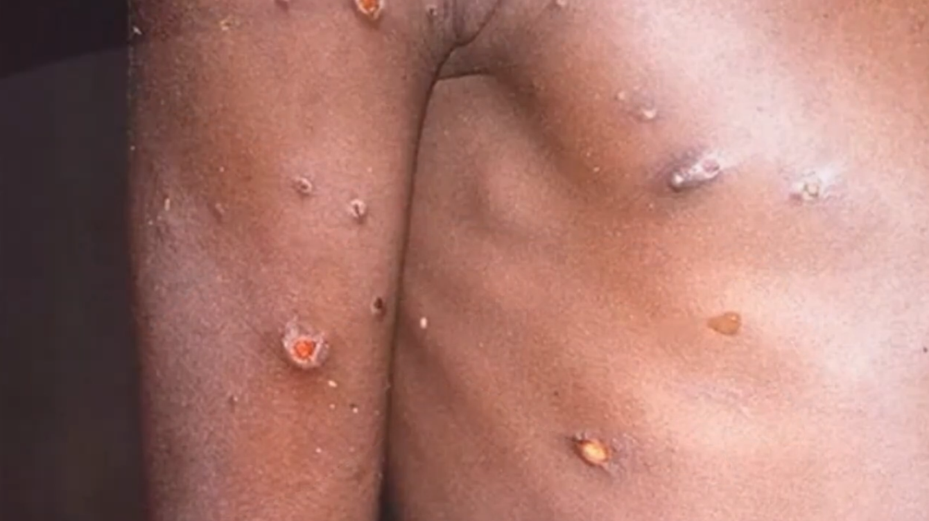 Roughly 20 Contacts of Monkeypox Patients in Home Quarantine